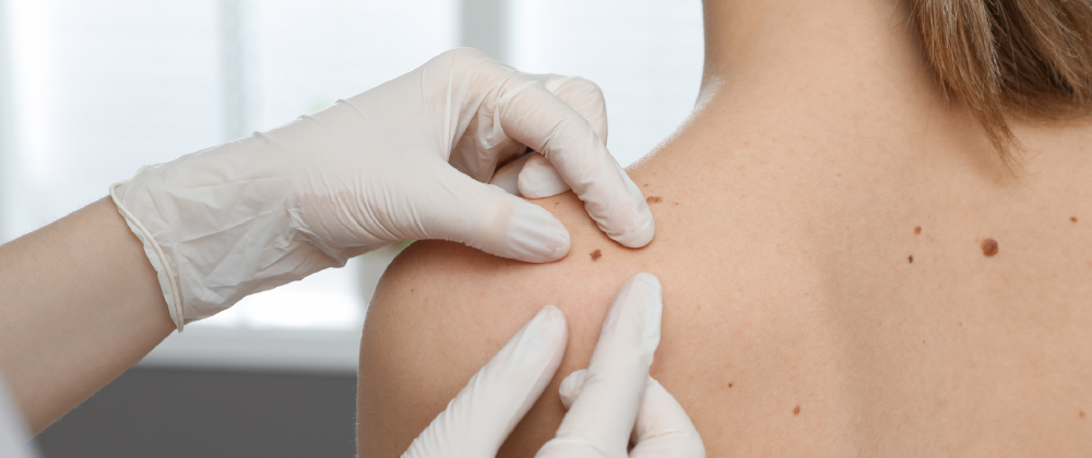 The role of Surgery in the treatment of Melanoma